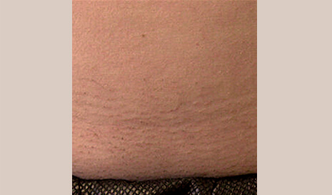LightSheer Laser Hair Removal Treatments - Permanent Laser Hair Reduction |  