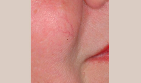 broken capillaries treatment face